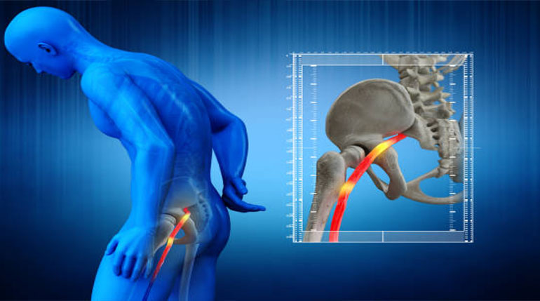 rwa kulszowa co robić