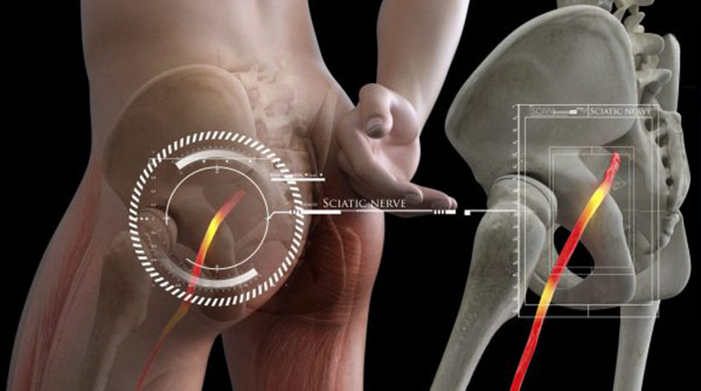 rwa kulszowa przyczyny